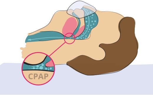 CPAP Therapien 